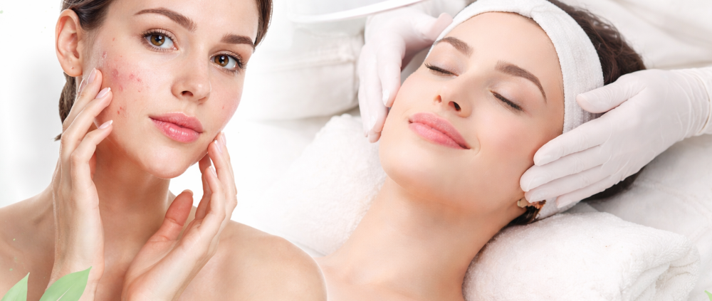 akne-behandlung Frau mit Hautunreinheiten und Akne vor einer professionellen Gesichtsbehandlung im Kosmetikstudio
